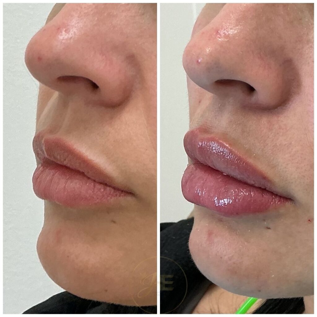 Relleno de labios Juvederm en Miami - Paciente 3 vista diagonal