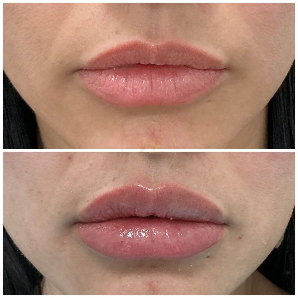 Relleno de labios Juvederm en Miami - Paciente 3 vista frontal