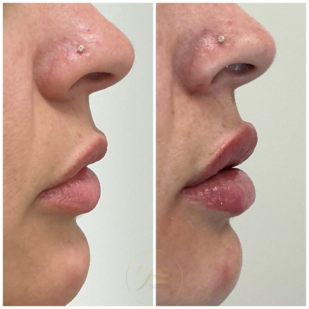 Relleno de labios Juvederm en Miami - Paciente 3 vista perfil